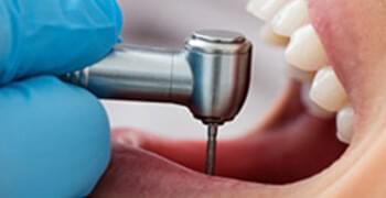 Dental-Implant-Surgery-Redlands