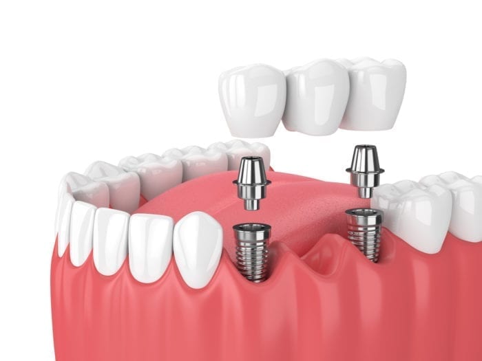 Implant Supported Overdenture in Redlands