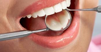 Teeth-Whitening-service